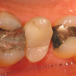 prämolar1