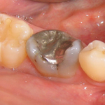 Amalgam Füllung